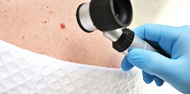 Znamiona skórne – kiedy zmiana wymaga weryfikacji klinicznej?
