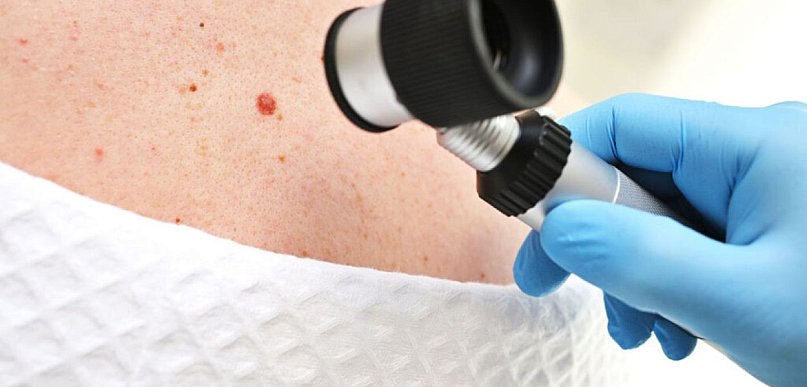 Znamiona skórne – kiedy zmiana wymaga weryfikacji klinicznej?