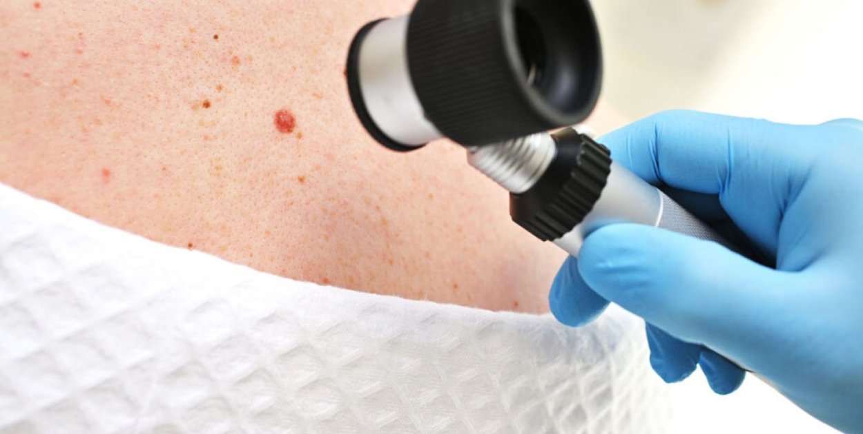 Znamiona skórne – kiedy zmiana wymaga weryfikacji klinicznej?
